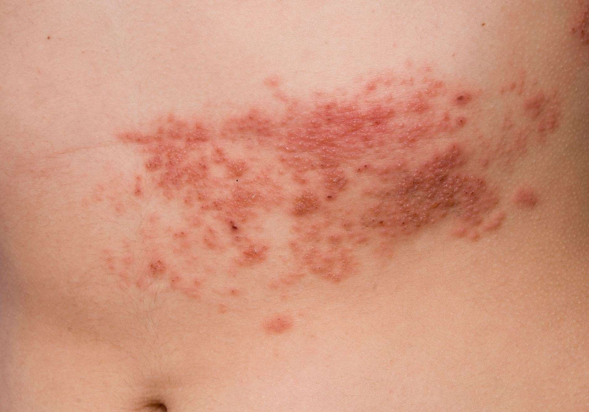 Those with shingles develop a painful rash. Image: iStock.