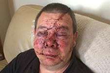 Colin Harvey suffered horrific facial injuries in the attack