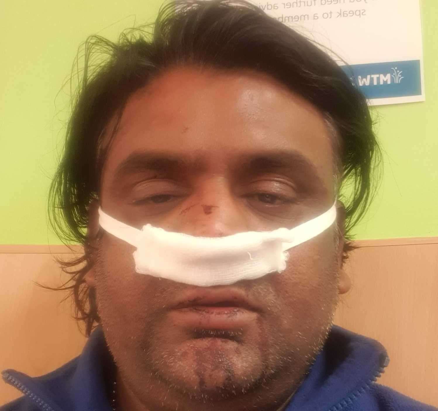 The 49-year-old had to go to hospital with a broken nose. Picture: Umesh Patel