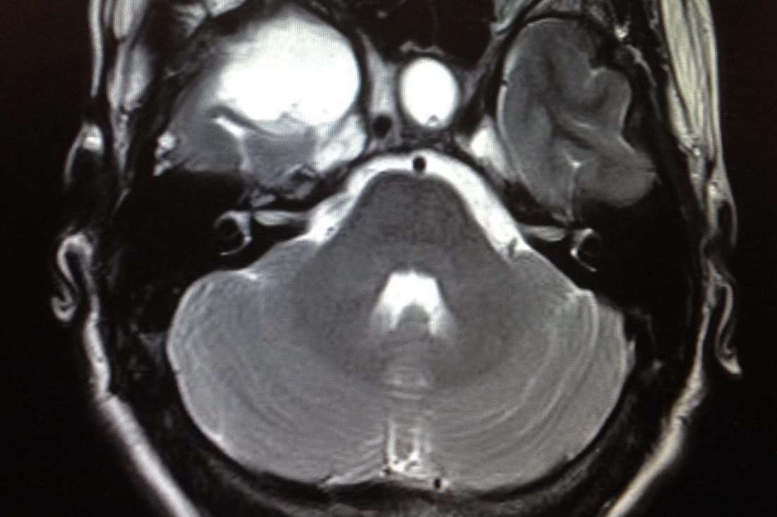 A scan revealed a benign tumour pushing against Lauren’s pituitary gland