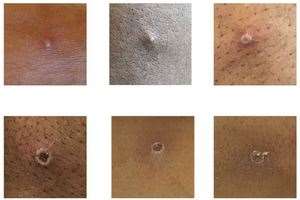 How monkeypox lesions can look