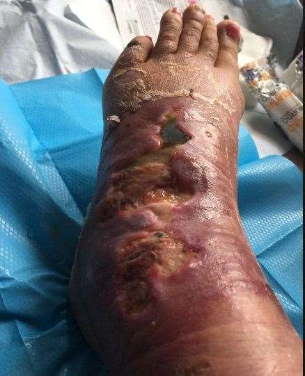 Faye Wilke's foot begain to rot after she was bitten in Bendorm. Picture: SWNS