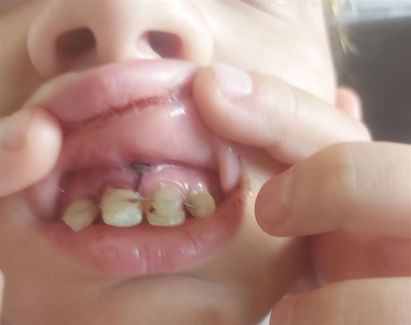 Denis-Cristian Bulancea, 12, with his tooth in place after pulling it out on a children's castle slide in Beachfields, Sheerness