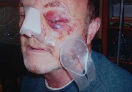 INNOCENT VICTIM: A vicious thug did this to Graham Hart