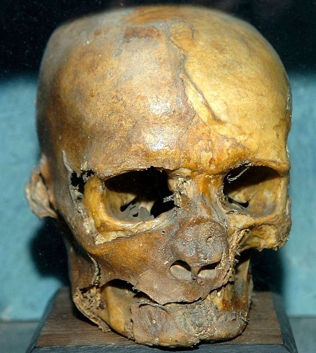 The skull of Simon of Sudbury