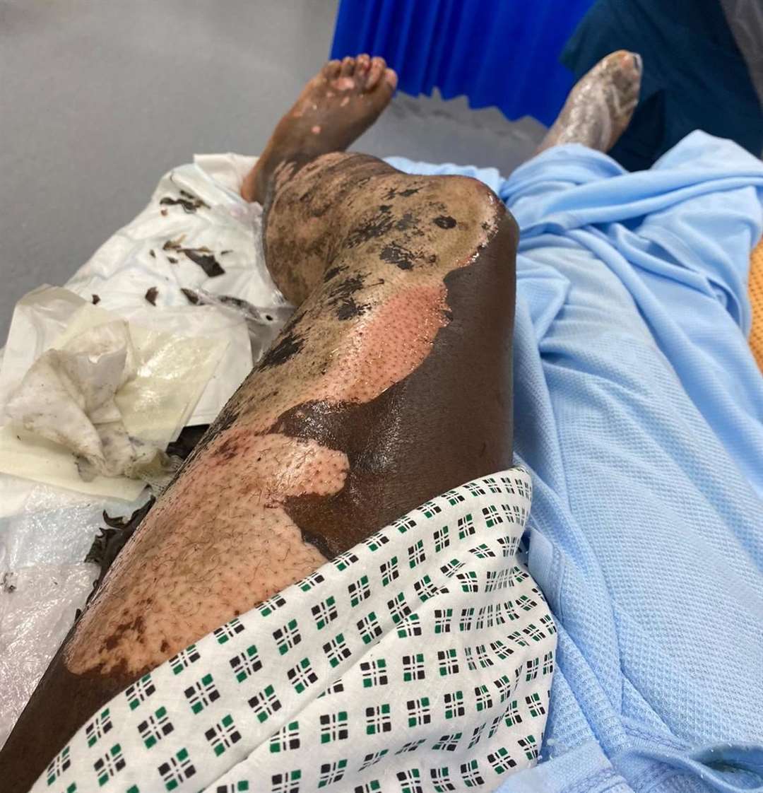 WARNING GRAPHIC IMAGE: Femi is to receive a skin graft