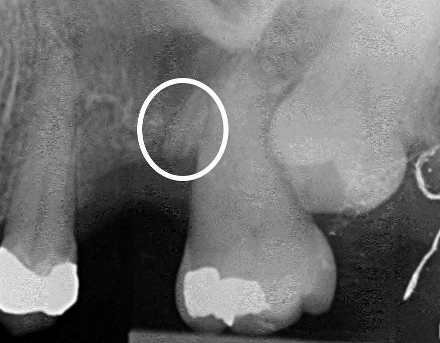 The retained root, circled, Ms Luxford claims contributed to her dental problems. Photo: The Dental Law Partnership/GoodRelations