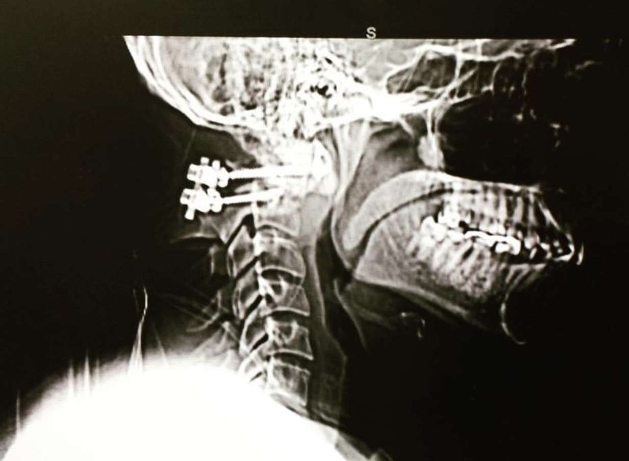 An X-ray revealed the damage to the 36-year-old's neck.