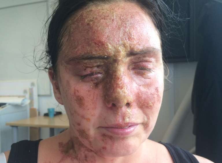 Carla Whitlock after the acid burns. Photo: Hampshire Police