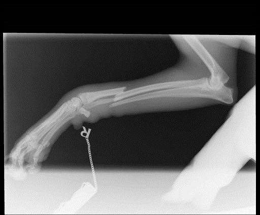 X-ray of Steve's badly broken right leg