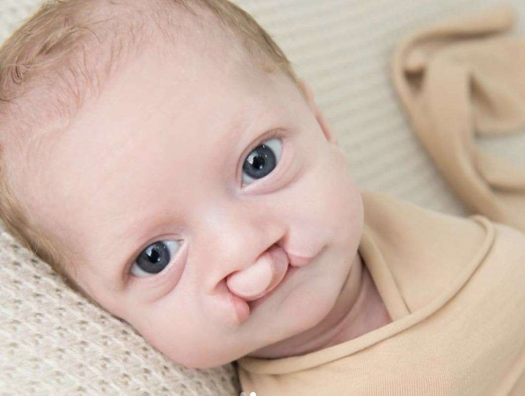 A bilateral cleft lip means that there are splits on both sides of the lip. Picture: Don't Get Lippy UK
