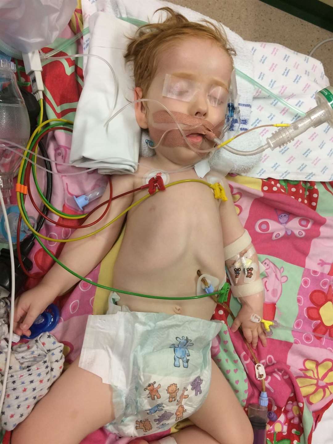 Ezra has almost died 10 times due to complications from SMA type 1