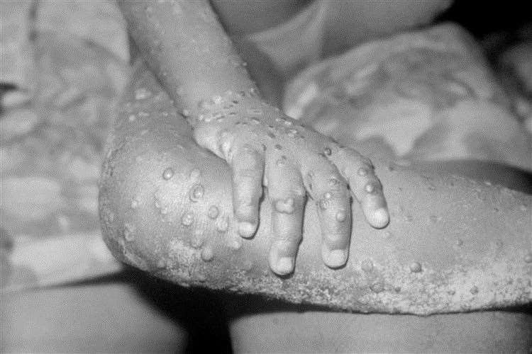 Three suspected monkeypox cases have been found in Kent. Picture: Alamy/PA