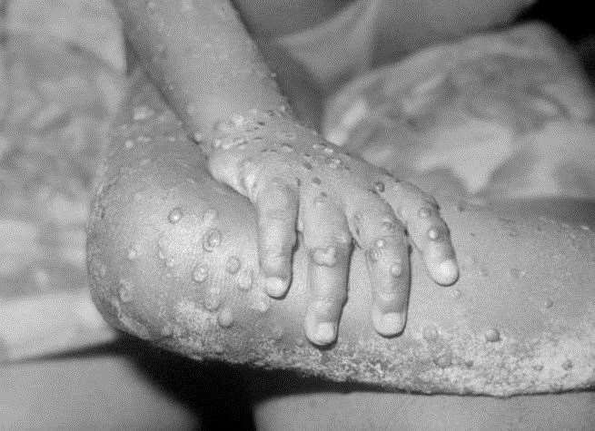 Further suspected cases of monkeypox have been identified in Kent. Picture: Alamy/PA