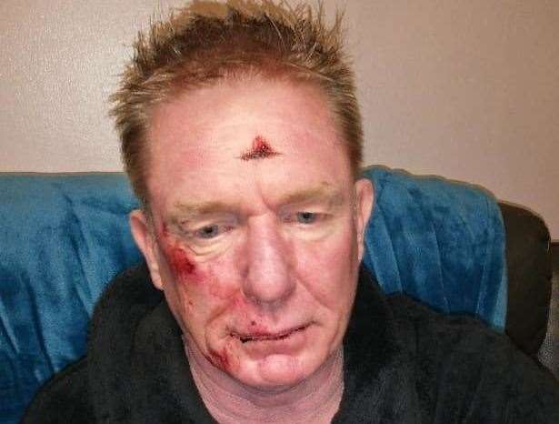 Martin Nicholls suffered nasty facial injuries (8083022)