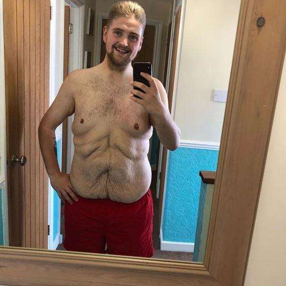 The 21-year-old is planning to have surgery to remove loose skin. Picture: Jack Towers
