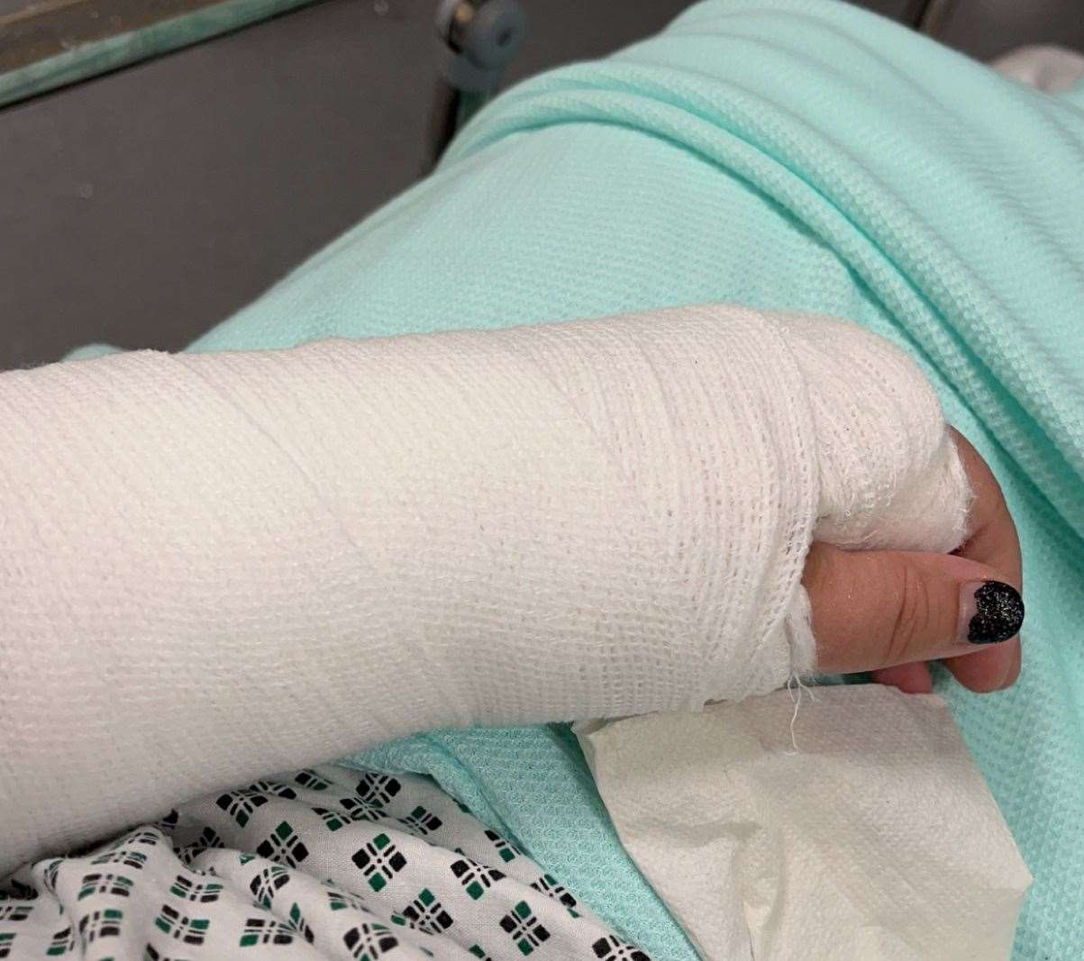 Sarah suffered a broken radius in her left arm from the fall