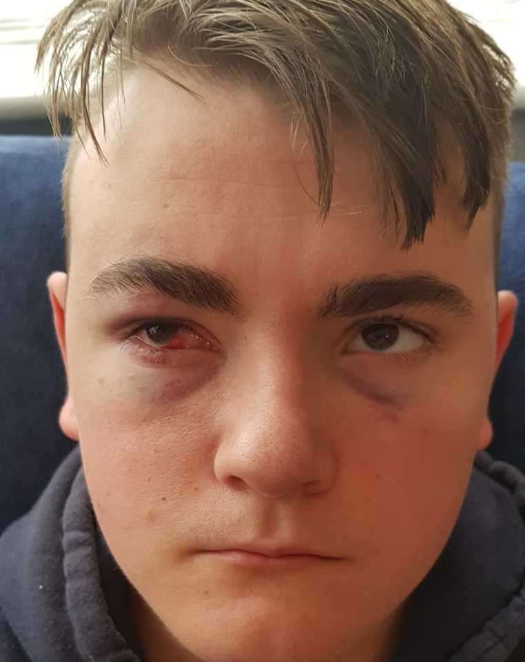Rhys Philips, 18, was left with a fractured eye socket after the attack