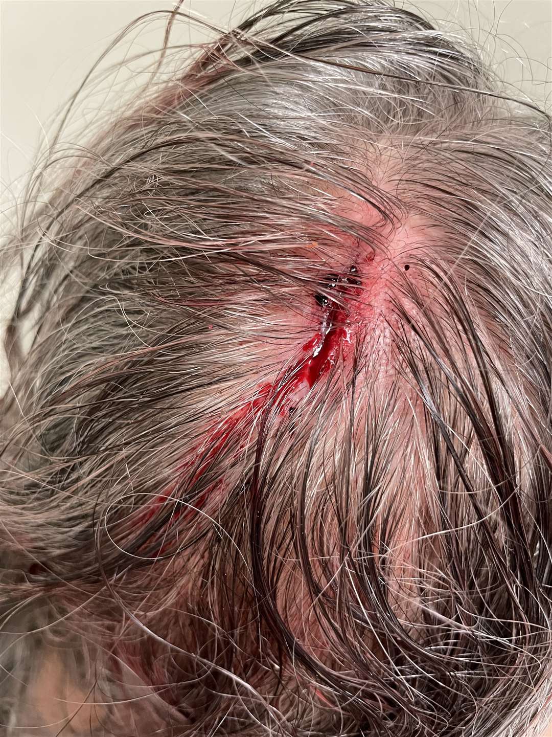 Mark needed staples in his head following the attack