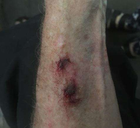 Glenn Bowman suffered a nasty bite to his forearm