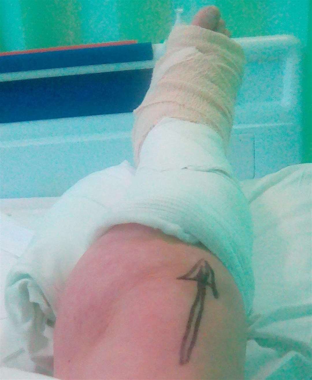 Susan Bidgood's injured leg (4910405)
