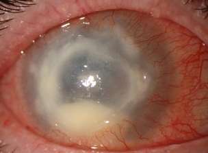 An eye infected with acanthamoeba. Stock image