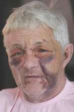 BEATEN SENSELESS: Ron McAllister says he is frightened to be alone. Picture: PETER STILL