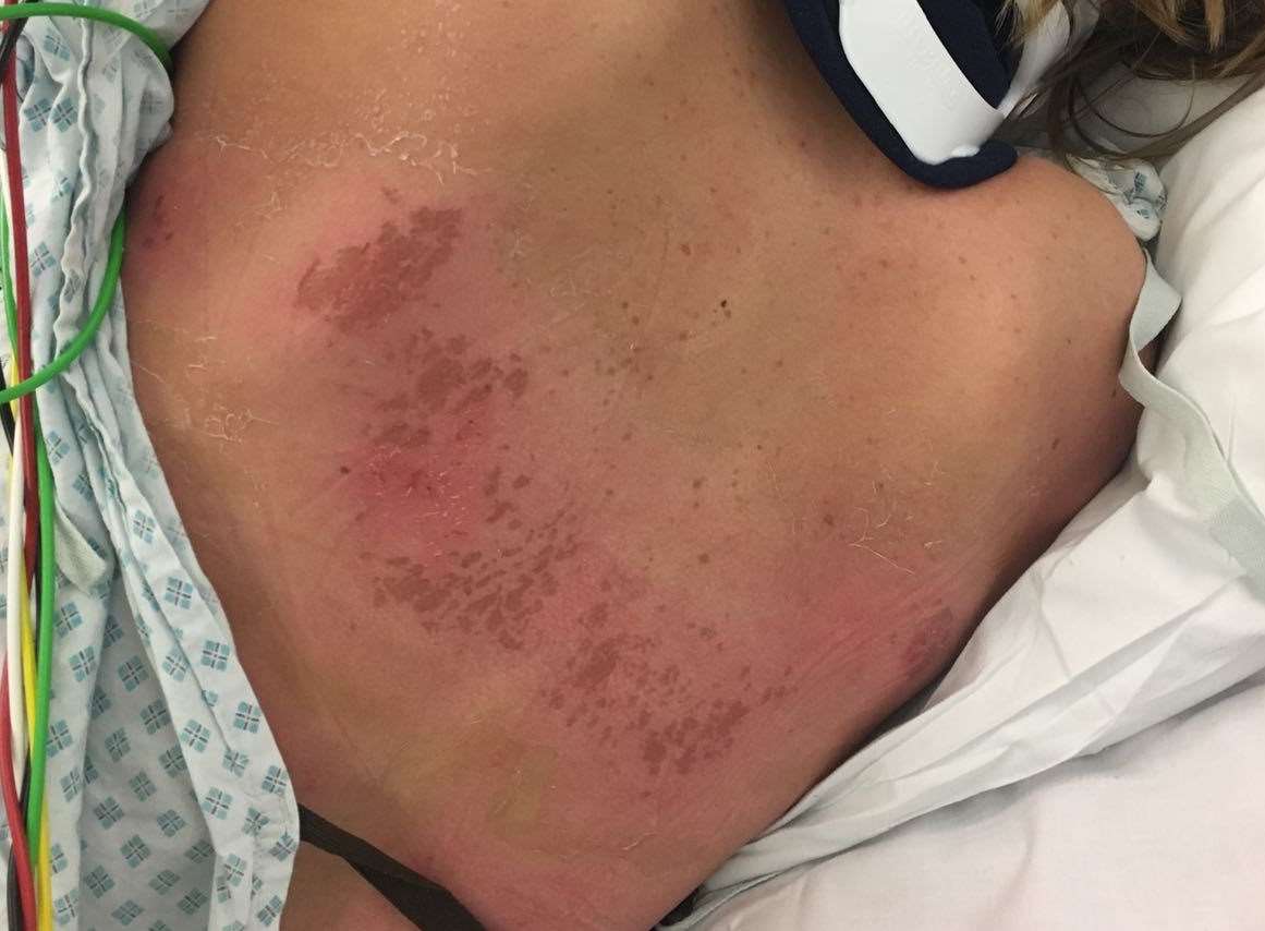 Marks on Caroline Wood’s back were found as she was treated in hospital