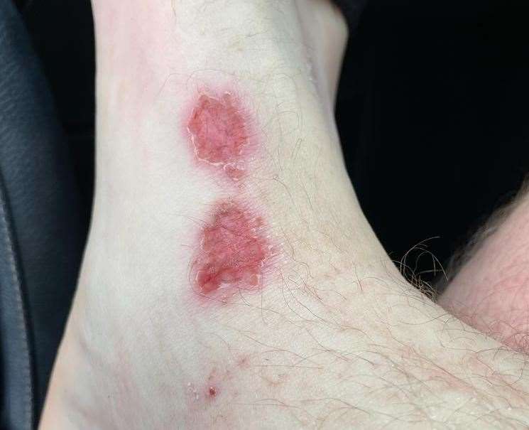 Alex initially went to the GP with itchy skin. Picture: Alex Watson