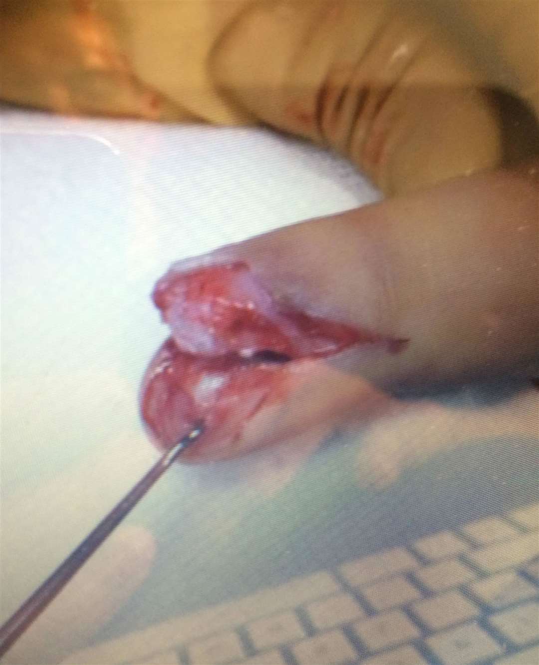 The injured finger