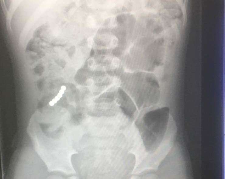 An x-ray clearly showed the magnets lodged inside Mickey's colon. Picture: Elaine Hambly
