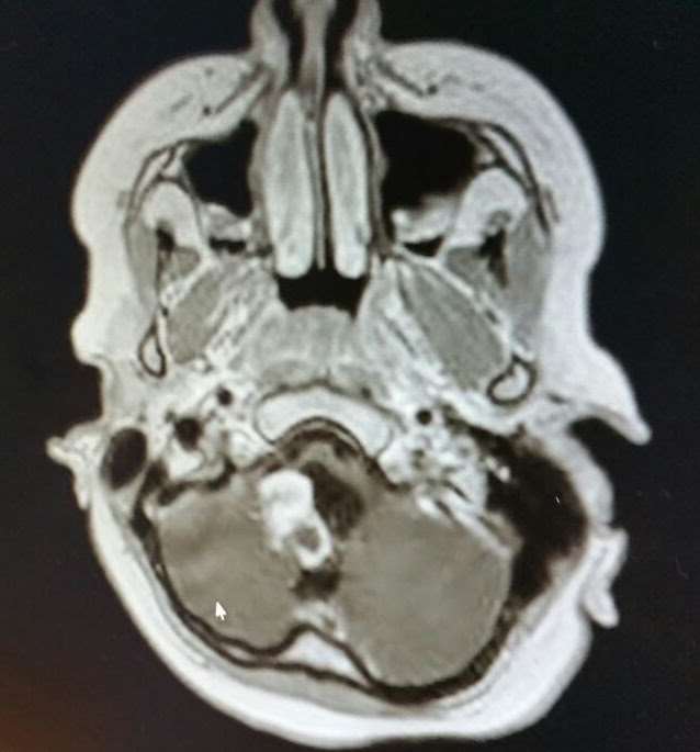 The scan showing Poppy's tumour