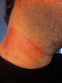 Iain McGee's injured neck after he was thrown off his motorbike