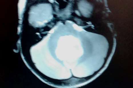 The golf ball-sized brain tumour, pictured in white, on a scan