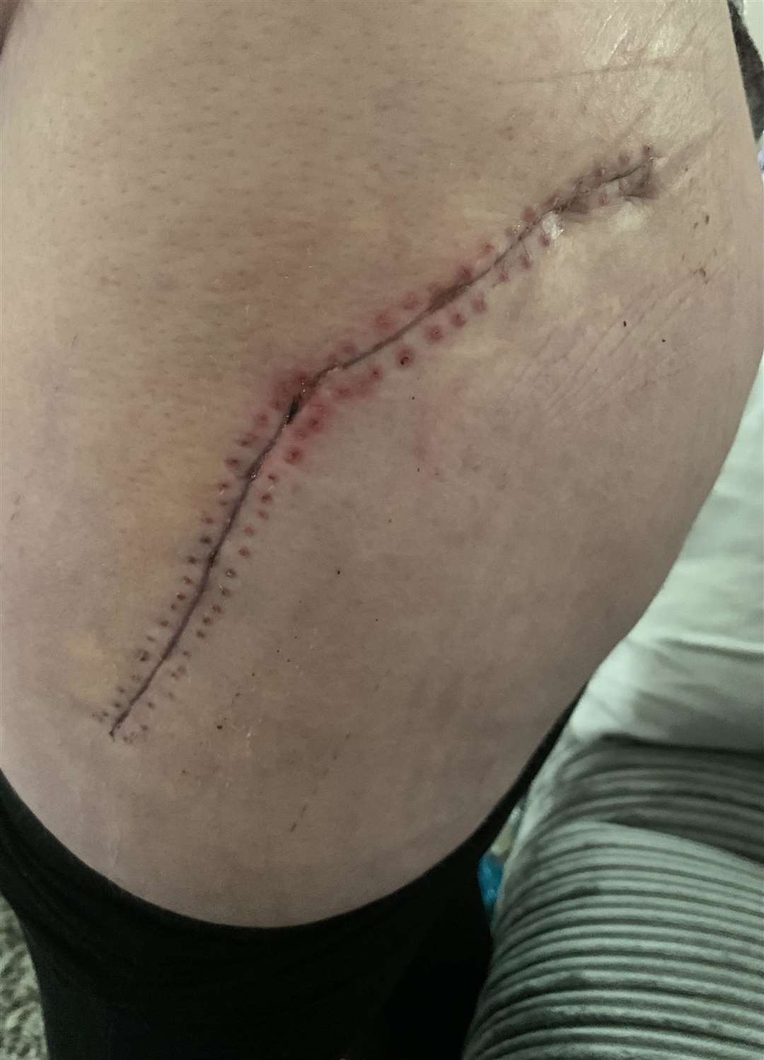 Denise's scar following her hip replacement