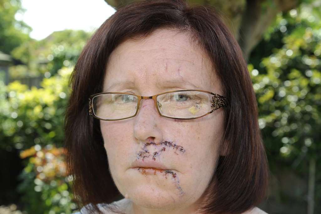 Angie Winterton from Selsey Avenue, Herne Bay, who injured her face falling off of her bike
