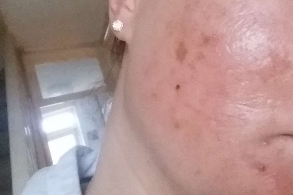 Chantelle Currell's face burnt and blistered after using a well known face mask
