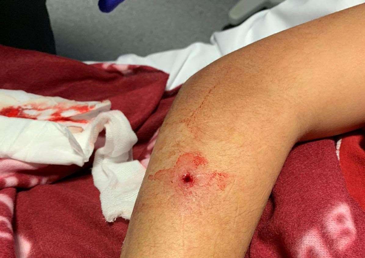 The injury on the teenager's arm