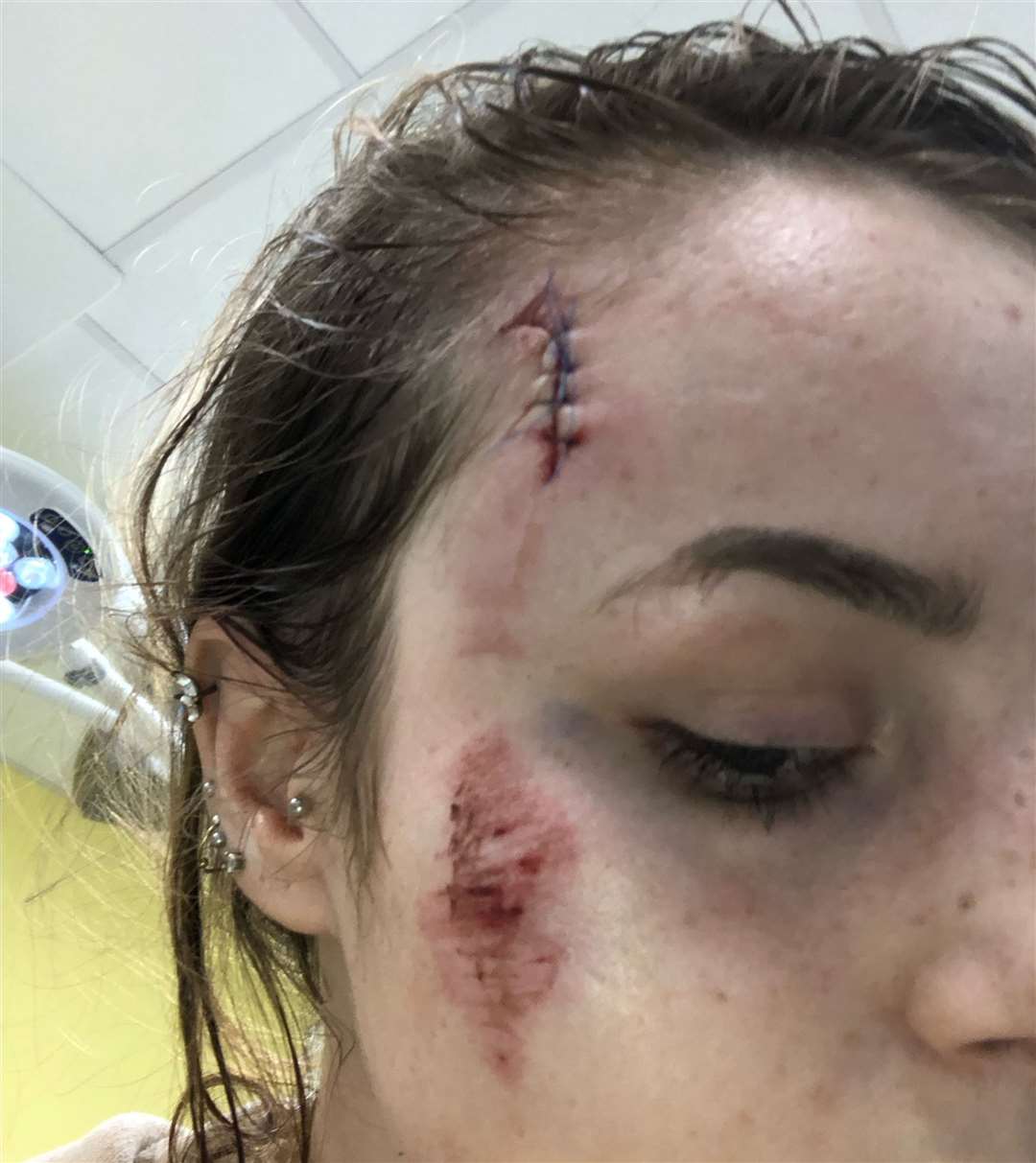 Eliza Eastland, 21, was left with stitches in a head wound