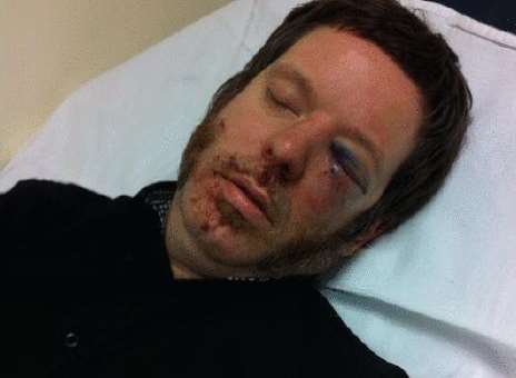 Ringo Woolgar suffered a fractured eye socket