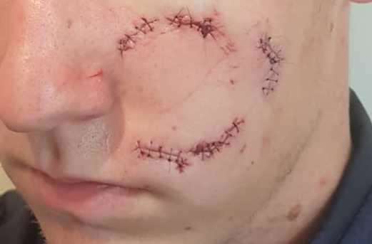 The teenager had the bottle shoved in his face causing this injury
