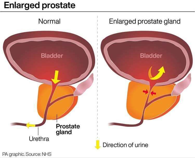 Prostate cancer can become life-threatening if left untreated. Picture: PA Graphics