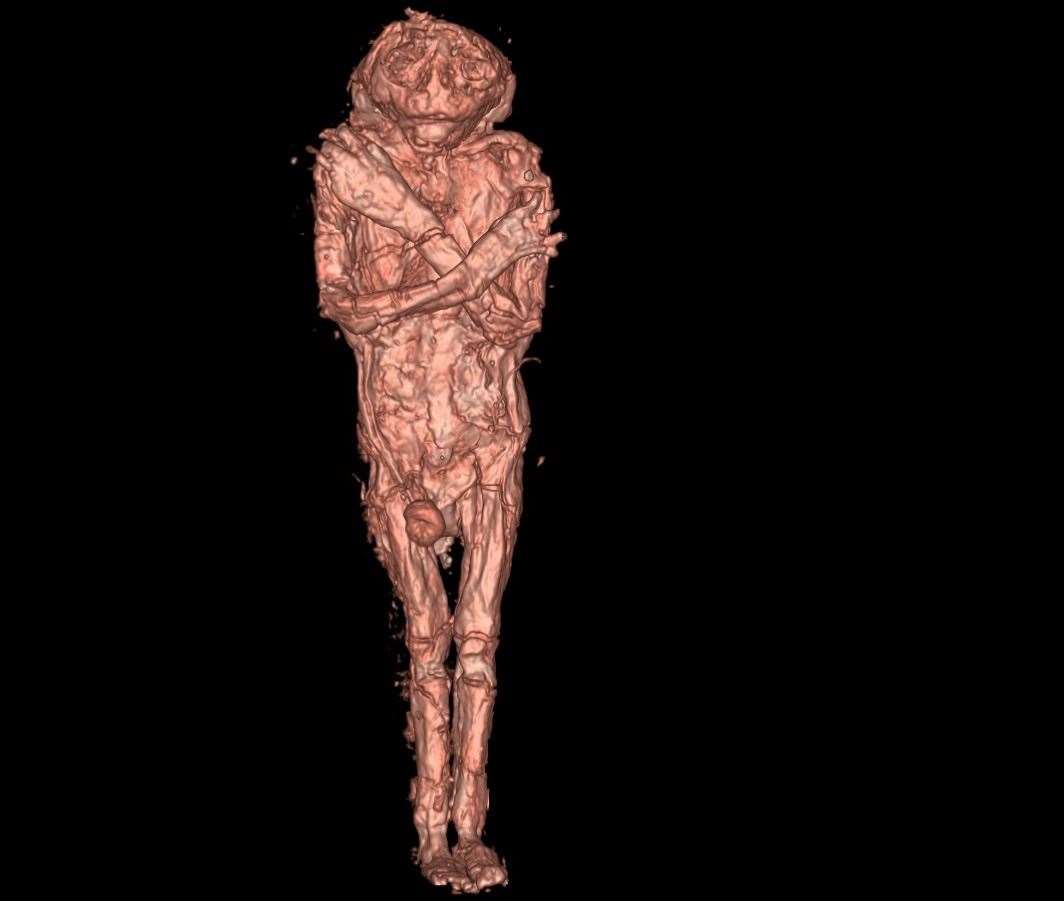 The CT-Scan image of the mummified foetus