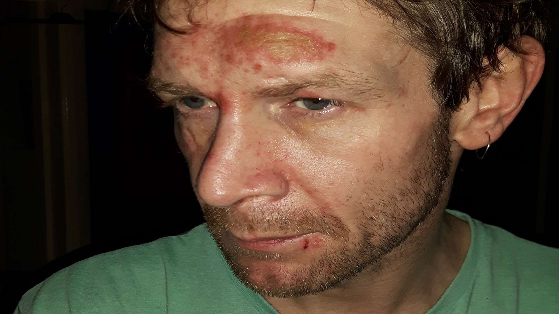 Justin Vincent's facial injuries after the acid attack