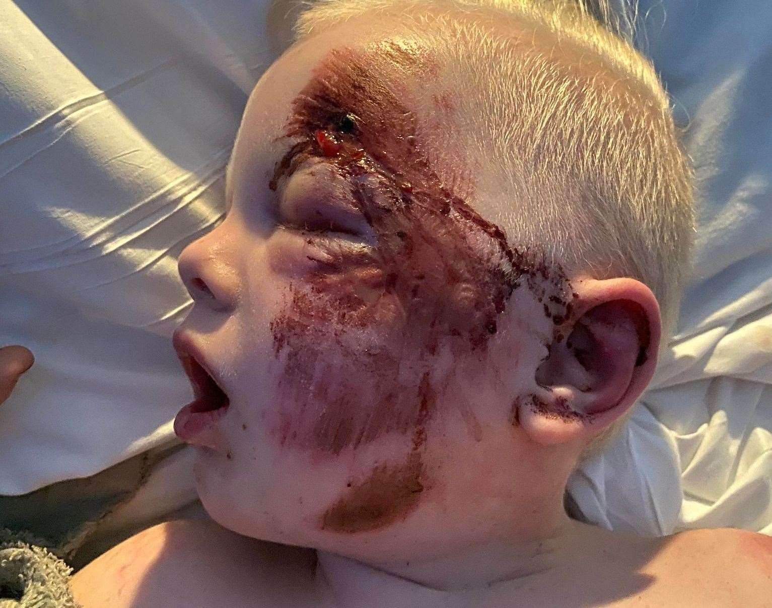 The injuries the four-year-old boy sustained after being hit by a car in Bell Road, Sittingbourne. Picture: Ethan Cording
