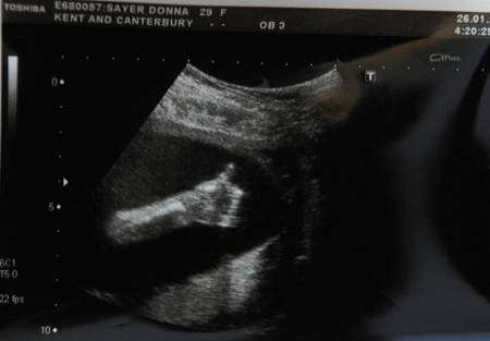Donna Sayer's baby scan gives a thumbs up!