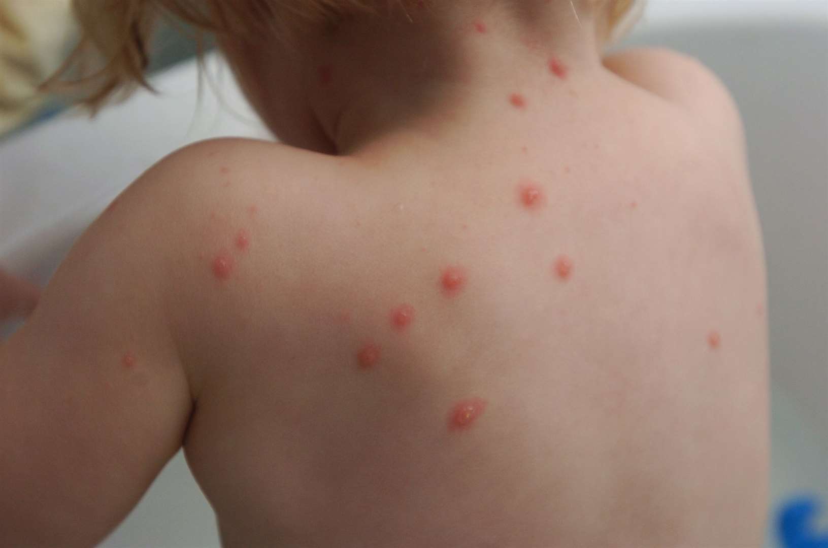 Experts now believe children should be protected against chickenpox. Image: Matt Walker.