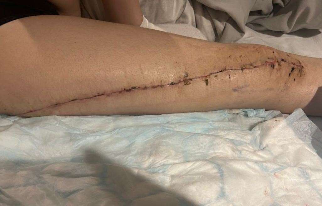 The scar left of Ivie Adam's leg after the surgery to remove her femur bone