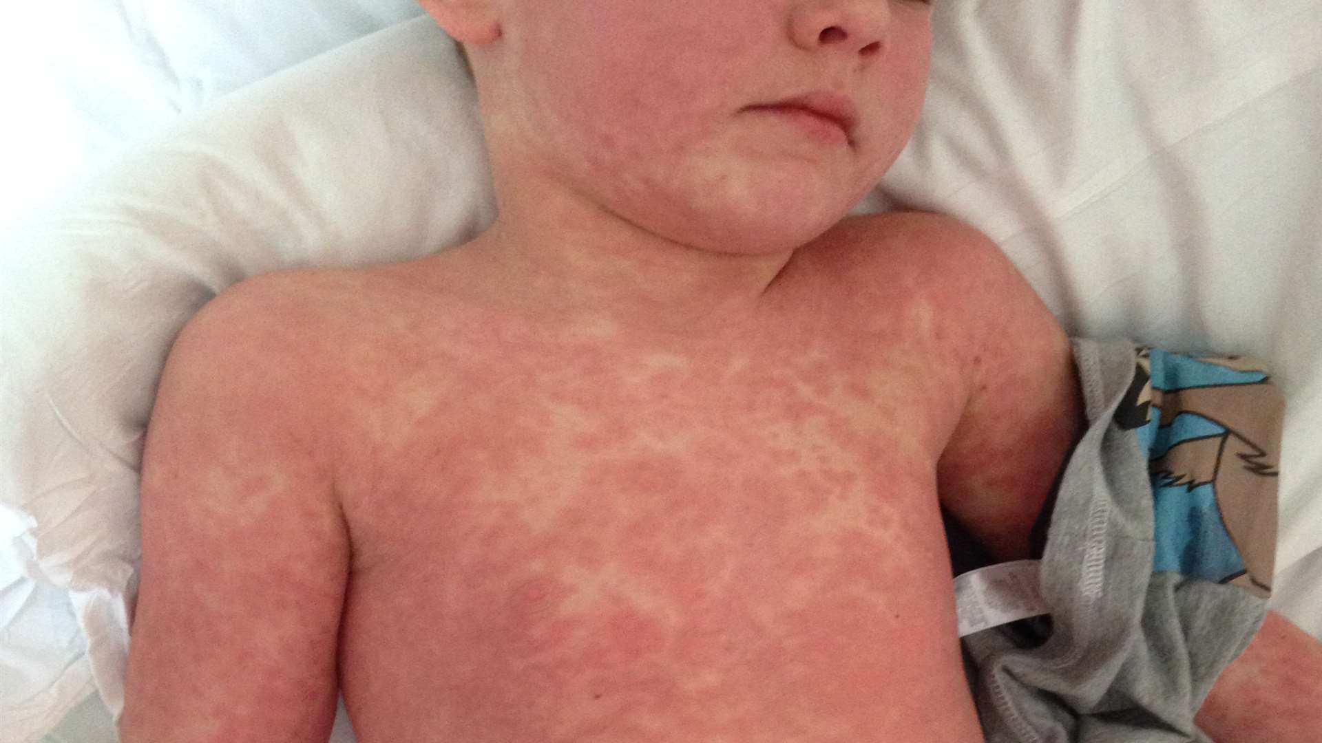 The mystery rash which left George Pemble, eight, in agony