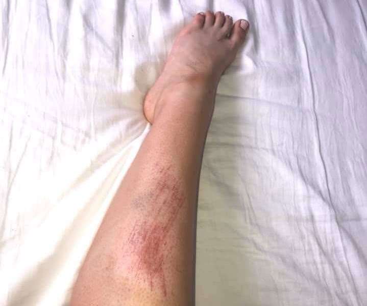 Aleksandra's leg after she cleaned up at home in Brompton Farm Lane Strood (13351532)